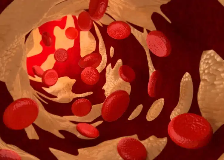High Cholesterol Arteries Image