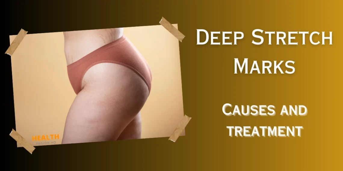 Deep Stretch Marks Main Article Image