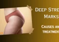 Deep Stretch Marks Main Article Image